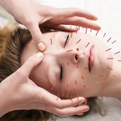 Can Cosmetic Acupuncture Tackle the Signs of Ageing?