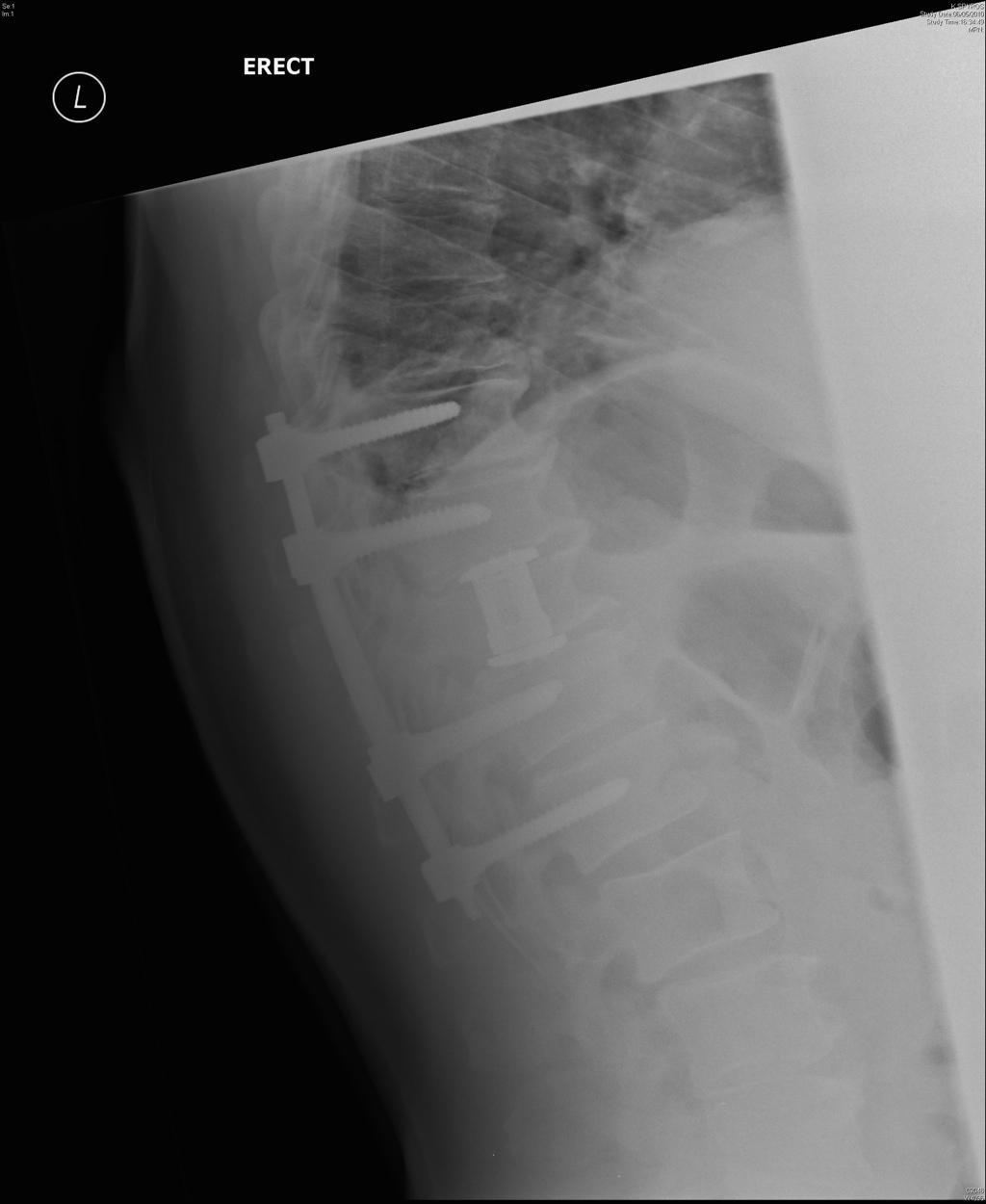 Everything you need to know about spinal cancer Doctify